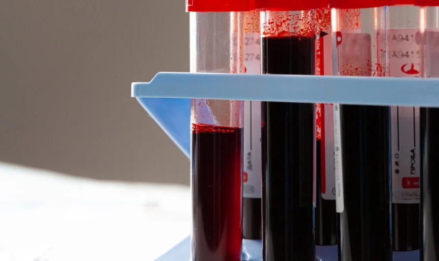 La HAS (France) recommande de ne plus prescrire la vitesse de sédimentation